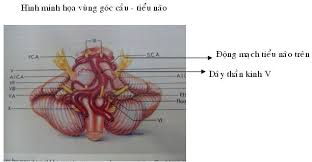 ĐIỀU TRỊ DỊ DẠNG ĐỘNG TĨNH MẠCH NÃO BẰNG XẠ PHẪU GAMMA KNIFE: KINH NGHIỆM TẠI BỆNH VIỆN CHỢ RẪY