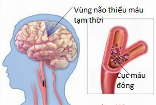 Nghiên cứu biến chứng sau đột quị thiếu máu não cục bộ