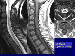 PHÂN LOẠI LIỆT HAI CHI DƯỚI DO TỔN THƯƠNG TỦY BẰNG CỘNG HƯỞNG TỪ VÀ DỊCH NÃO TỦY