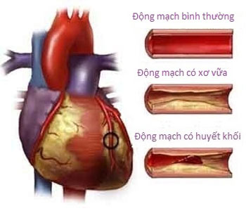 Nghiên cứu đặc điểm lâm sàng, hình ảnh của nhồi máu não do xơ vữa hệ động mạch cảnh trong