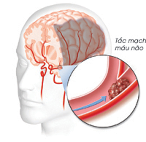 Một số ý kiến về Nghiên cứu tai biến mạch máu não