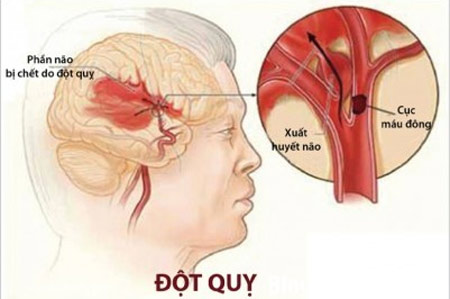 Tiêu chuẩn chất lượng xử trí đột quỵ não ở Việt Nam