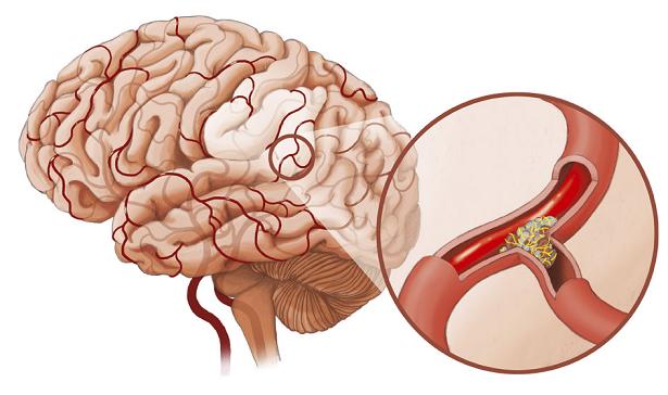 Nghiên cứu sự hồi phục ở bệnh nhân sau tai biến mạch máu não có tăng huyết áp sau 1 năm và một số yếu tố liên quan