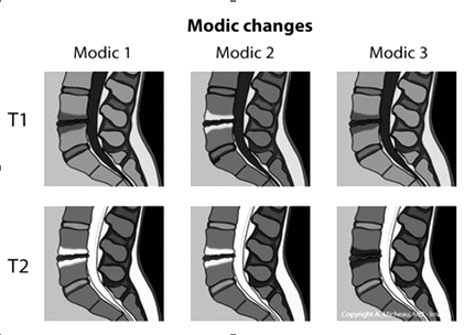 4. Phương pháp chẩn đoán thoái hóa Modic 2