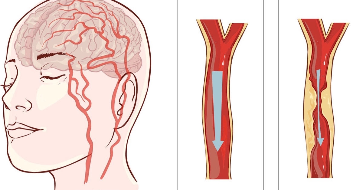 Hội chứng Parkinson do mạch máu